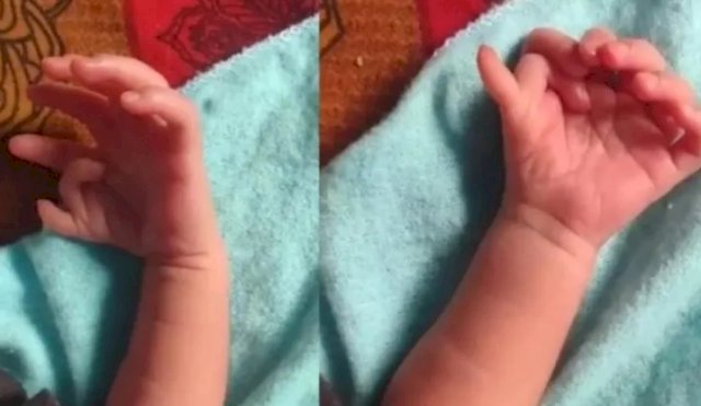 Nació una beba con siete dedos en cada mano y seis en cada pie